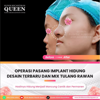 Hasil Rhinoplasty Queen Plastic Surgery, foto 59