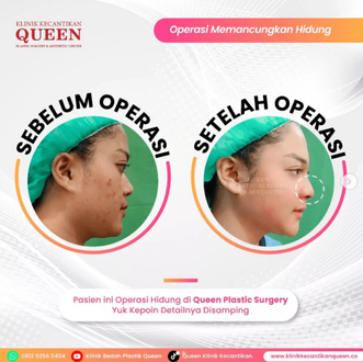 Hasil Rhinoplasty Queen Plastic Surgery, foto 47