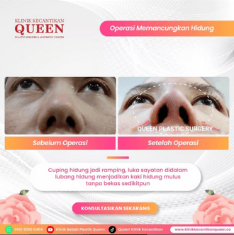 Hasil Rhinoplasty Queen Plastic Surgery, foto 49