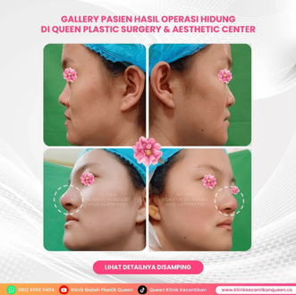 Hasil Rhinoplasty Queen Plastic Surgery, foto 50