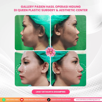 Hasil Rhinoplasty Queen Plastic Surgery, foto 51