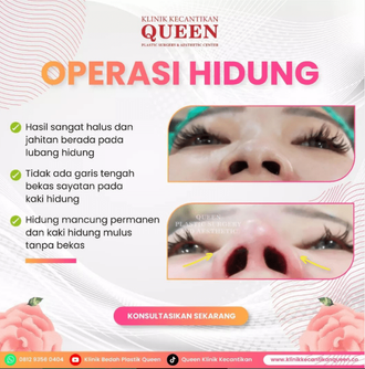 Hasil Rhinoplasty Queen Plastic Surgery, foto 52