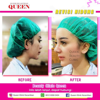 Hasil Rhinoplasty Queen Plastic Surgery, foto 55