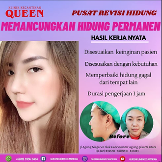 Hasil Rhinoplasty Queen Plastic Surgery, foto 56