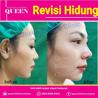 Hasil Rhinoplasty Queen Plastic Surgery, foto 57