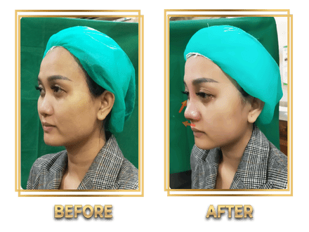 Hasil Rhinoplasty Queen Plastic Surgery, foto 58