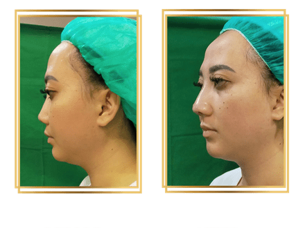 Hasil Rhinoplasty Queen Plastic Surgery, foto 46