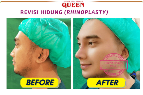 Hasil Rhinoplasty Queen Plastic Surgery, foto 45