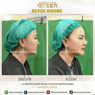 Hasil Rhinoplasty Queen Plastic Surgery, foto 44