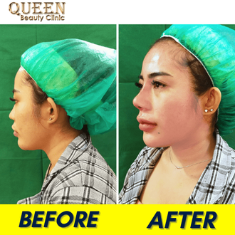 Hasil Rhinoplasty Queen Plastic Surgery, foto 43