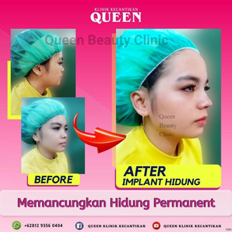Hasil Rhinoplasty Queen Plastic Surgery, foto 42