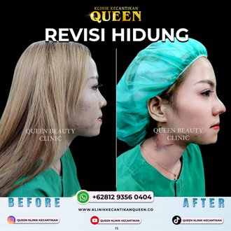 Hasil Rhinoplasty Queen Plastic Surgery, foto 41