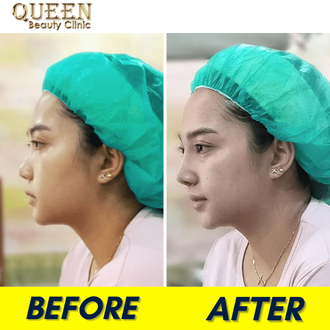 Hasil Rhinoplasty Queen Plastic Surgery, foto 40