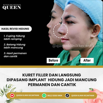 Hasil Rhinoplasty Queen Plastic Surgery, foto 39