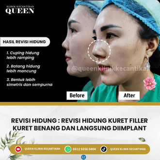 Hasil Rhinoplasty Queen Plastic Surgery, foto 38