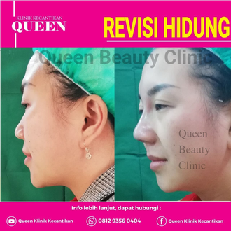 Hasil Rhinoplasty Queen Plastic Surgery, foto 35