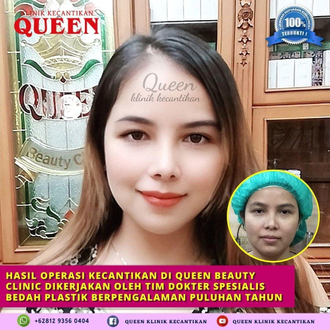 Hasil Rhinoplasty Queen Plastic Surgery, foto 23