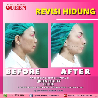 Hasil Rhinoplasty Queen Plastic Surgery, foto 24