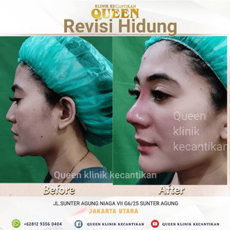 Hasil Rhinoplasty Queen Plastic Surgery, foto 25