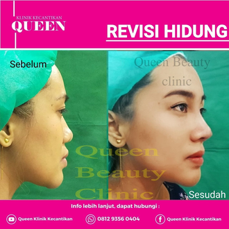 Hasil Rhinoplasty Queen Plastic Surgery, foto 26