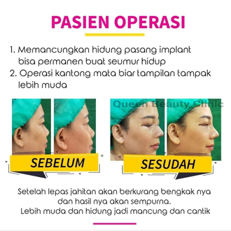 Hasil Rhinoplasty Queen Plastic Surgery, foto 29