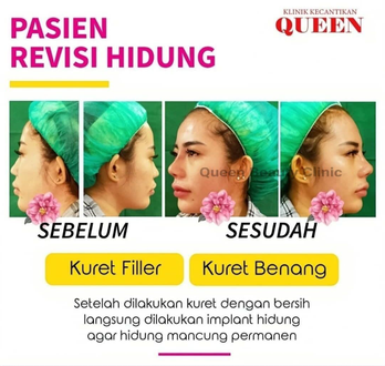 Hasil Rhinoplasty Queen Plastic Surgery, foto 30