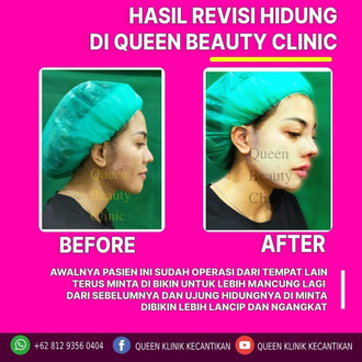 Hasil Rhinoplasty Queen Plastic Surgery, foto 31