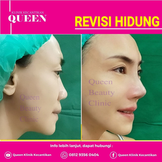 Hasil Rhinoplasty Queen Plastic Surgery, foto 33