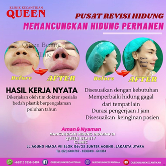 Hasil Rhinoplasty Queen Plastic Surgery, foto 34