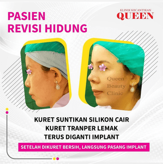 Hasil Rhinoplasty Queen Plastic Surgery, foto 22