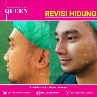 Hasil Rhinoplasty Queen Plastic Surgery, foto 21