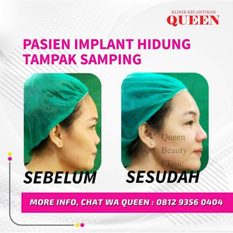 Hasil Rhinoplasty Queen Plastic Surgery, foto 20