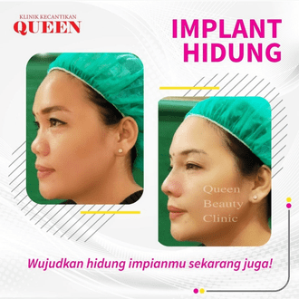Hasil Rhinoplasty Queen Plastic Surgery, foto 19