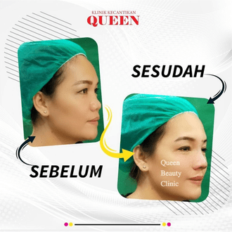Hasil Rhinoplasty Queen Plastic Surgery, foto 18