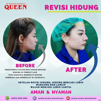 Hasil Rhinoplasty Queen Plastic Surgery, foto 17