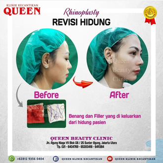 Hasil Rhinoplasty Queen Plastic Surgery, foto 15