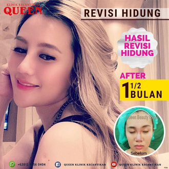 Hasil Rhinoplasty Queen Plastic Surgery, foto 14