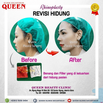 Hasil Rhinoplasty Queen Plastic Surgery, foto 13