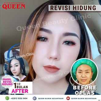 Hasil Rhinoplasty Queen Plastic Surgery, foto 12
