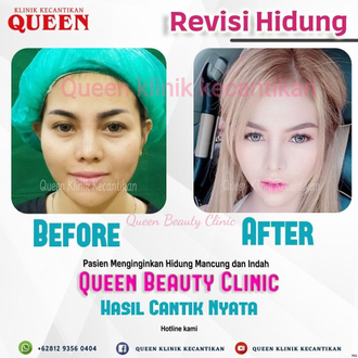 Hasil Rhinoplasty Queen Plastic Surgery, foto 11