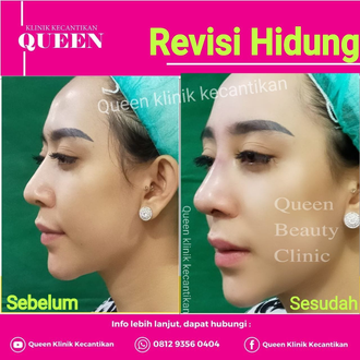 Hasil Rhinoplasty Queen Plastic Surgery, foto 2