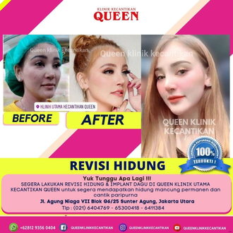 Hasil Rhinoplasty Queen Plastic Surgery, foto 3