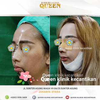 Hasil Rhinoplasty Queen Plastic Surgery, foto 4