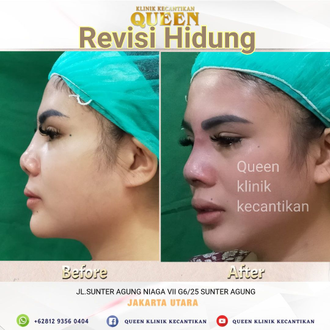 Hasil Rhinoplasty Queen Plastic Surgery, foto 5