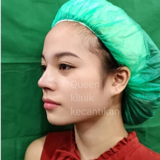 Hasil Rhinoplasty Queen Plastic Surgery, foto 6
