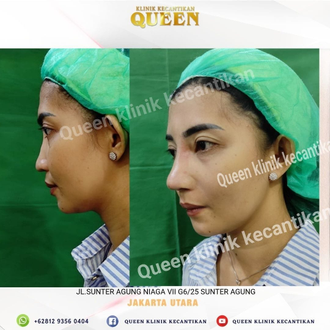 Hasil Rhinoplasty Queen Plastic Surgery, foto 8