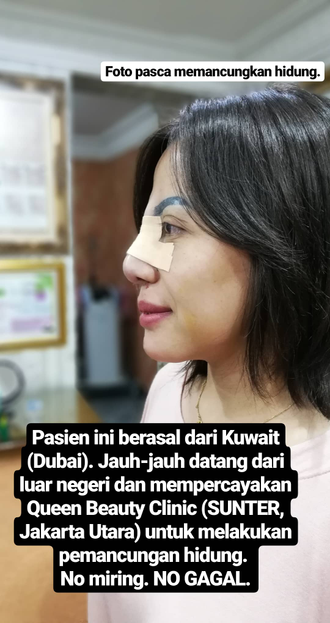 Hasil Rhinoplasty Queen Plastic Surgery, foto 9