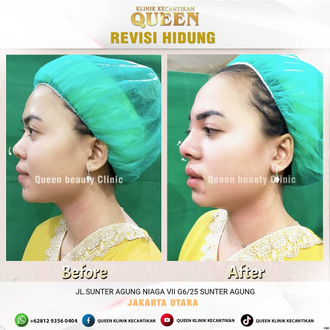 Hasil Rhinoplasty Queen Plastic Surgery, foto 1