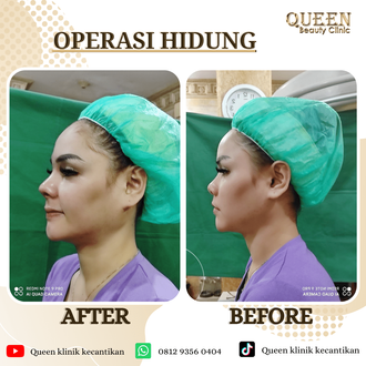 Hasil Rhinoplasty Queen Plastic Surgery, foto 100