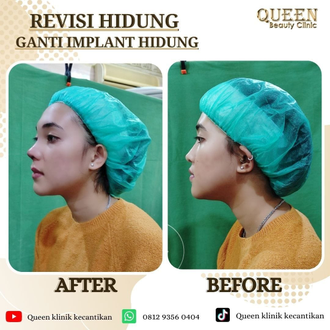 Hasil Rhinoplasty Queen Plastic Surgery, foto 99